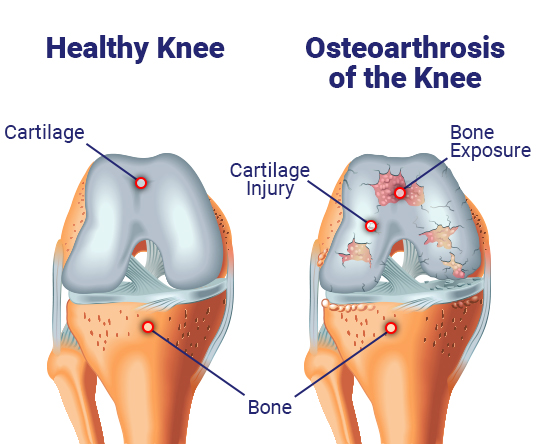 Anatomic picture of the knee shows the causes of arthritis_joint pain